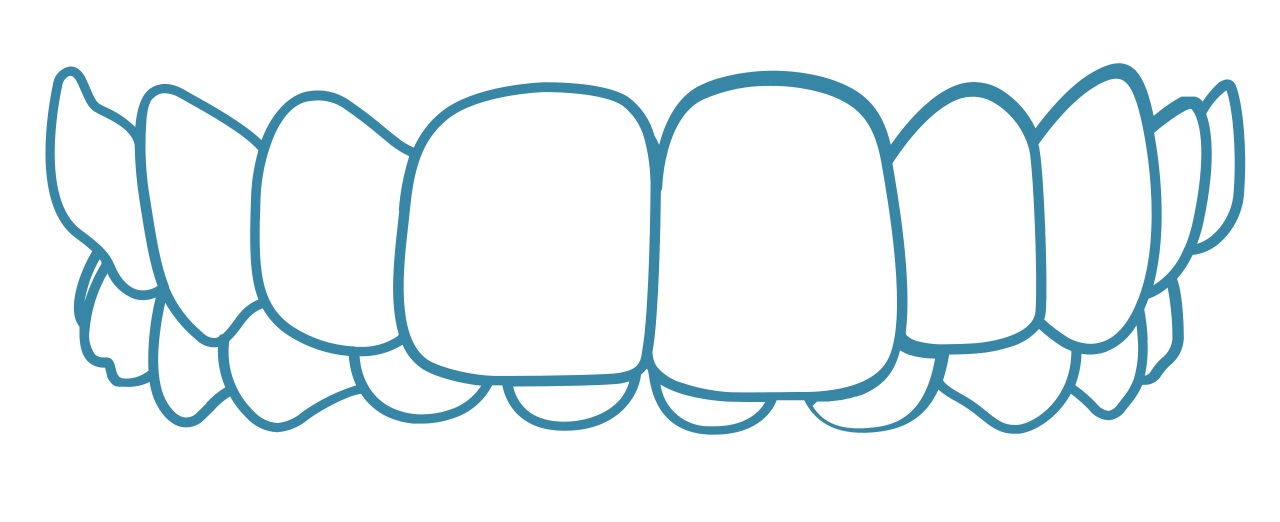 Invisalign-Overbite-dental-care-arlington-heights Invisalign-Overbite-dental-care-arlington-heights