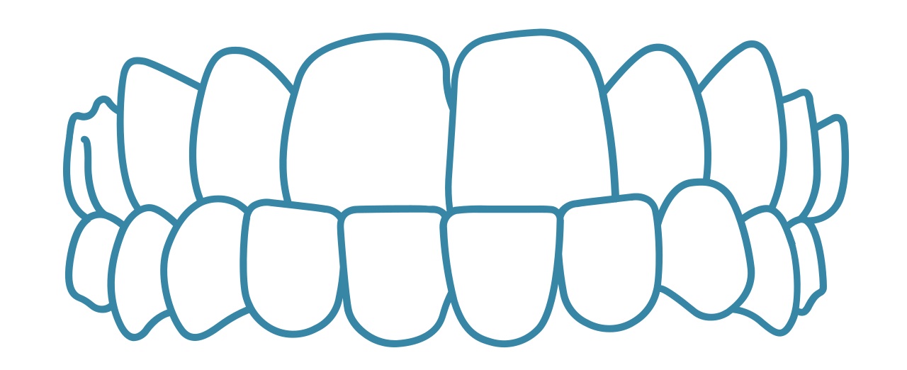 Invisalign-underbite-dental-care-arlington-heights Invisalign-underbite-dental-care-arlington-heights