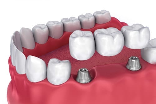 cosmetic-dentistry-bridges-and-crowns-dental-care-arlington-heights-04 cosmetic-dentistry-bridges-and-crowns-dental-care-arlington-heights-04