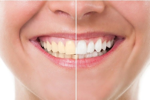 cosmetic-dentistry-teeth-whitening-dental-care-arlington-heights-05 cosmetic-dentistry-teeth-whitening-dental-care-arlington-heights-05