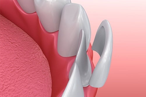 cosmetic-dentistry-veneers-dental-care-arlington-heights-02 cosmetic-dentistry-veneers-dental-care-arlington-heights-02