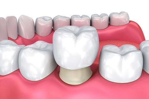 cosmetics-dentistry-crowns-dental-care-arlington-heights-03 cosmetics-dentistry-crowns-dental-care-arlington-heights-03