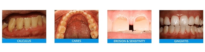 dental-care-arlington-heights-general-dentistry-fluoride-1X4 dental-care-arlington-heights-general-dentistry-fluoride-1X4