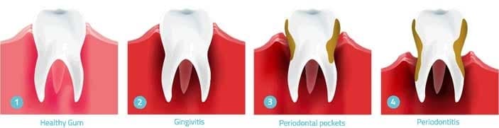 dental-care-arlington-heights-gum-disease-stages-long dental-care-arlington-heights-gum-disease-stages-long