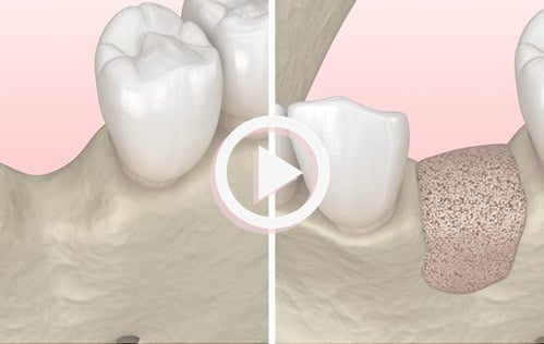 dental-implant-video-image-bone-grafing-dental-care-arlington-heights dental-implant-video-image-bone-grafing-dental-care-arlington-heights
