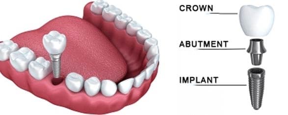 dental-implants-Crown-Abutmet-Implant-dental-care-arlington-heights dental-implants-Crown-Abutmet-Implant-dental-care-arlington-heights