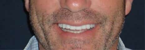 dentist-near-me-after-cosmetic-dentistry-dental-care-arlington-heights
