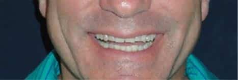 dentist-near-me-before-cosmetic-dentistry-dental-care-arlington-heights
