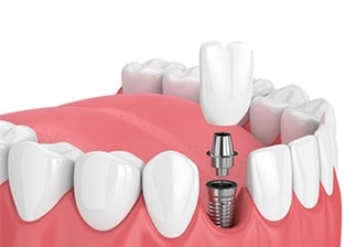 dentist-near-me-dental-care-arlington-heights (1)