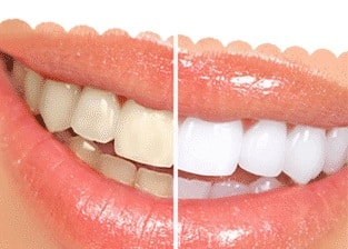 dentist-near-me-huntley-cosmetic-dentistry-dental-care-arlington-heights