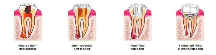 general-dentistry-root-canal-1X4-dental-care-arlington-heights general-dentistry-root-canal-1X4-dental-care-arlington-heights