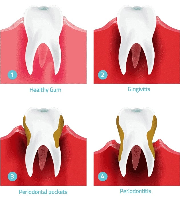 gum-disease-stages-dental-care-arlington-heights gum-disease-stages-dental-care-arlington-heights