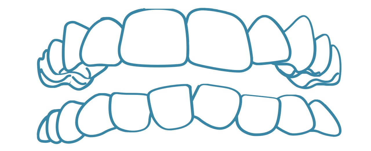invisalign-crooked-teeth-dental-care-arlington-heights invisalign-crooked-teeth-dental-care-arlington-heights