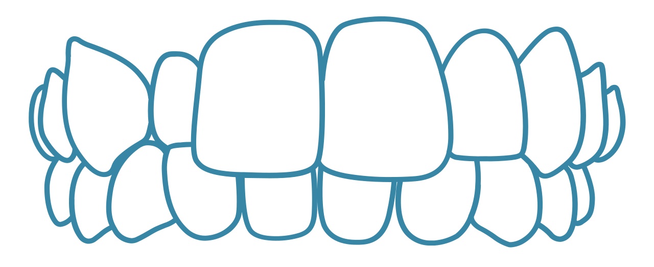 invisalign-crossbite-dental-care-arlington-heights invisalign-crossbite-dental-care-arlington-heights