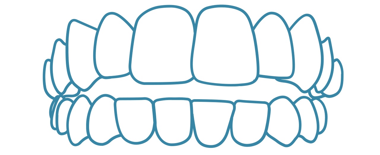 invisalign-open-bite-dental-care-arlington-heights invisalign-open-bite-dental-care-arlington-heights