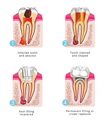 root-canal-treatment-dental-care-arlington-heights root-canal-treatment-dental-care-arlington-heights